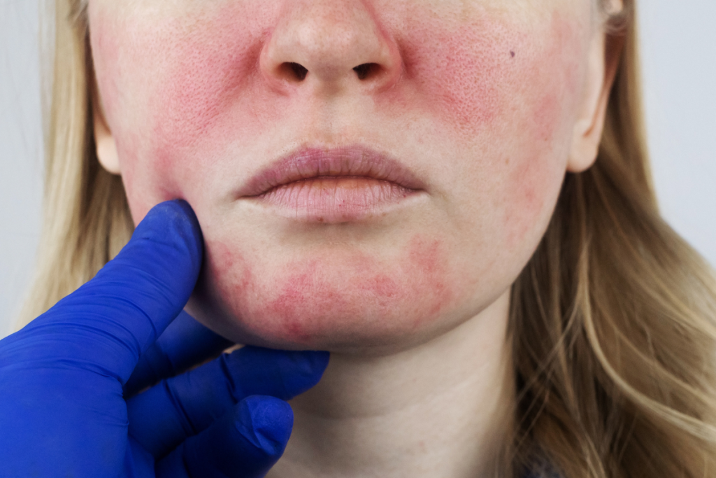 living with rosacea
