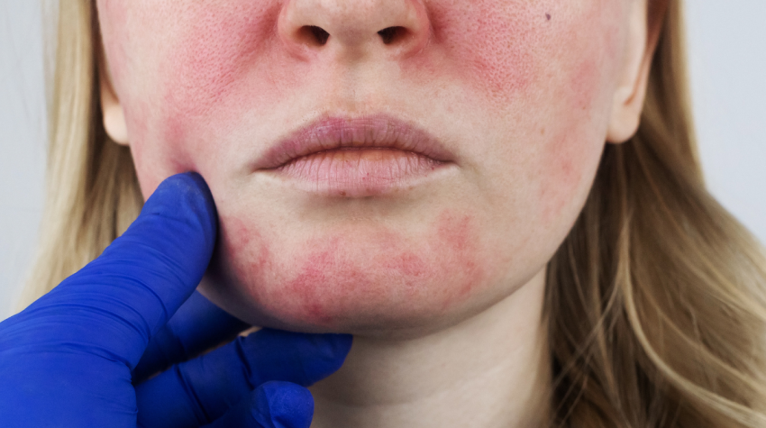a woman with rosacea is examined by a doctor