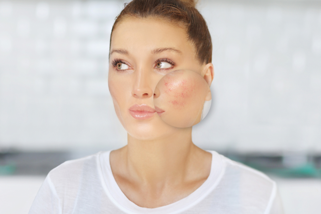 talk to your doctor for medications and topical ointments to help with rosacea