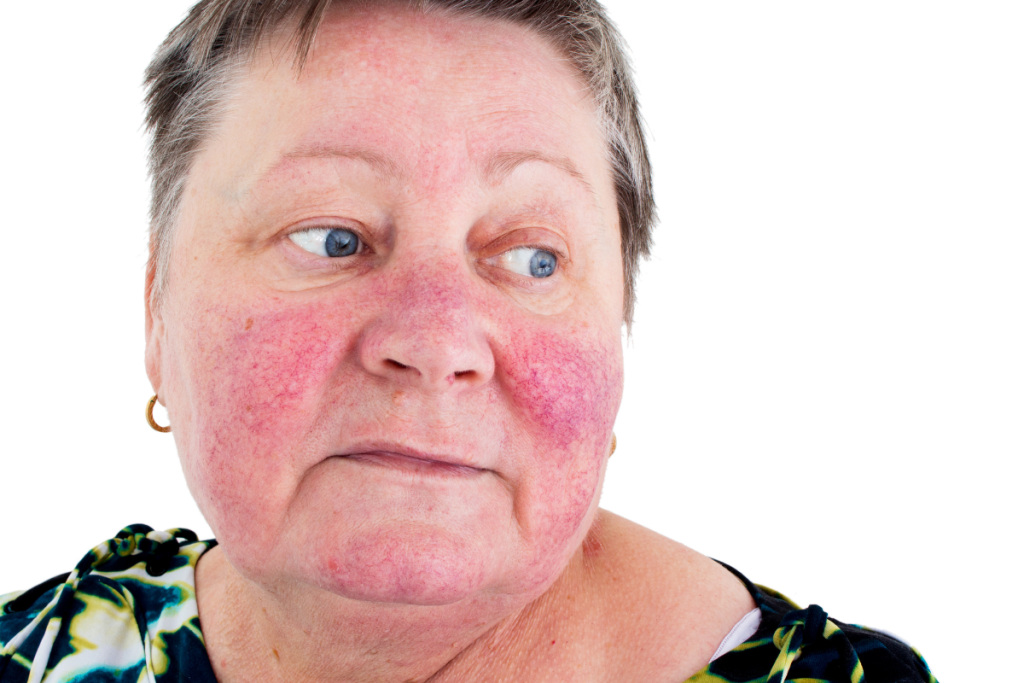 emotional stress from living with rosacea